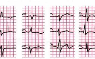Астматическая форма инфаркта миокарда симптомы