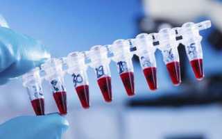Высокий уровень тромбоцитов в крови у мужчин