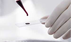 Формула клинического анализа крови расшифровка