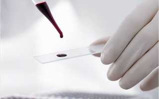 Формула клинического анализа крови расшифровка