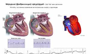 Трепыхание сердца причины симптомы и лечение