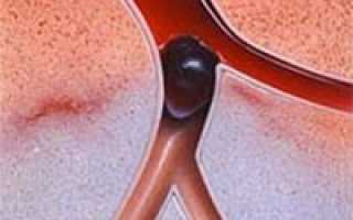 Варикозное расширение вен органов малого таза