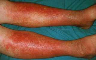 Варикозный дерматит нижних конечностей симптомы