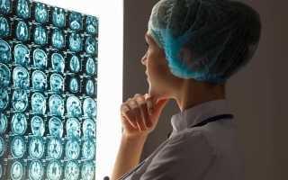 Виды инсульта головного мозга и последствия