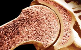 Опухоль костного мозга симптомы у взрослого