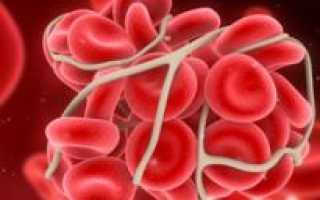 Как определить повышенную свертываемость крови