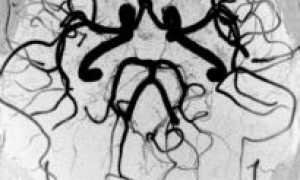 Аплазия правой задней соединительной артерии