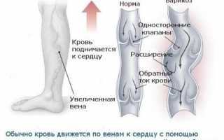 Варикоз на ногах причины симптомы и лечение