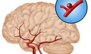 Как лечить аневризму сосудов головного мозга